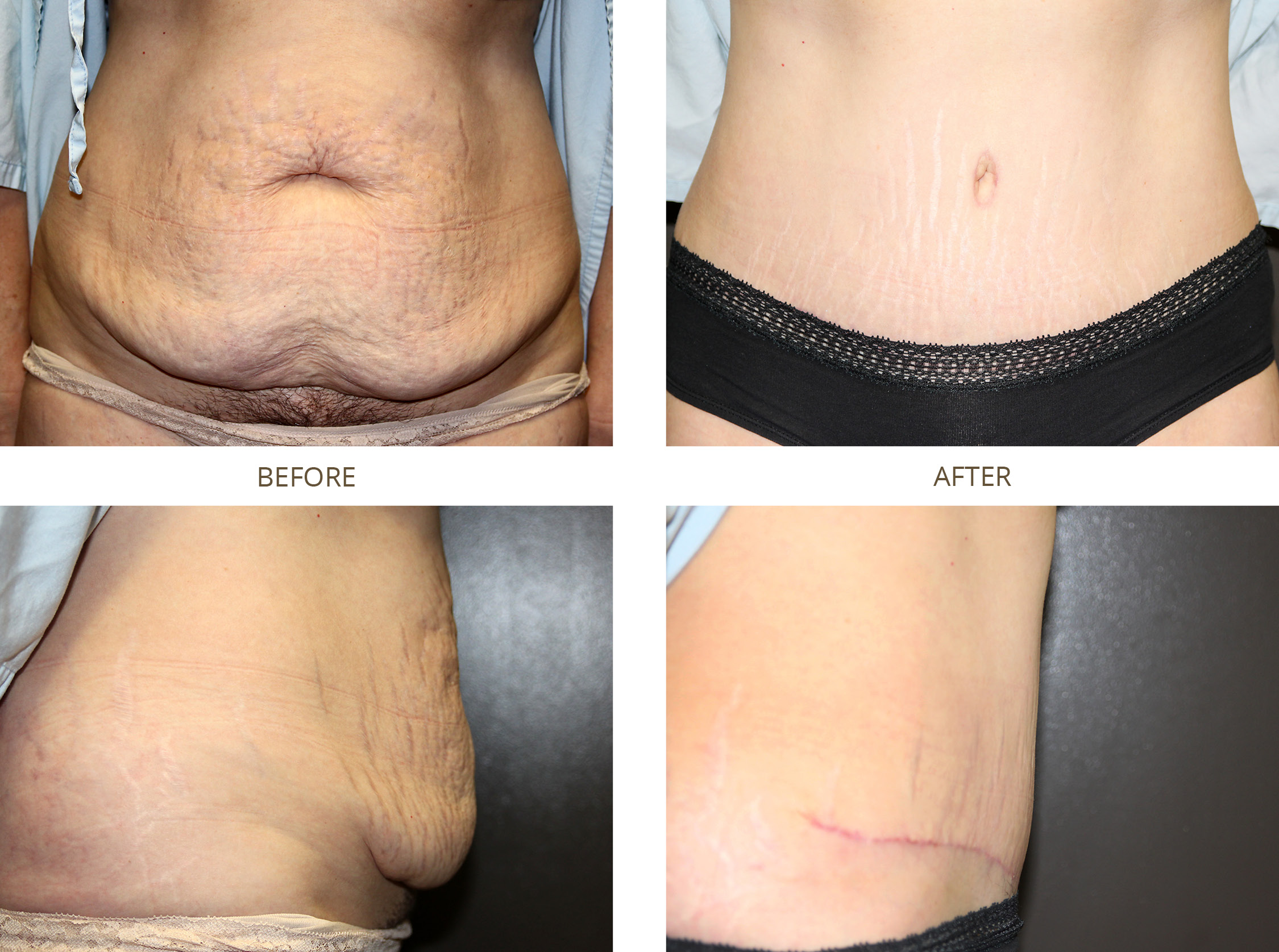 Before and After Gallery of Tummy Tuck.